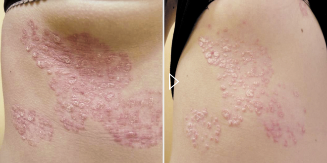 Ārstēšana - foto līdz и после