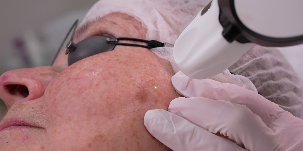 Pigmentēto bojājumu ārstēšana (Pinpoint Coagulation™)