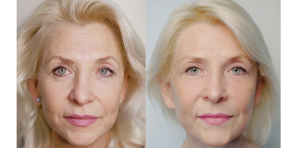 Er:YAG 2940 nm + SMA modulis (RecoSMA®) - ablācijas un reģenerācijas emitētājs