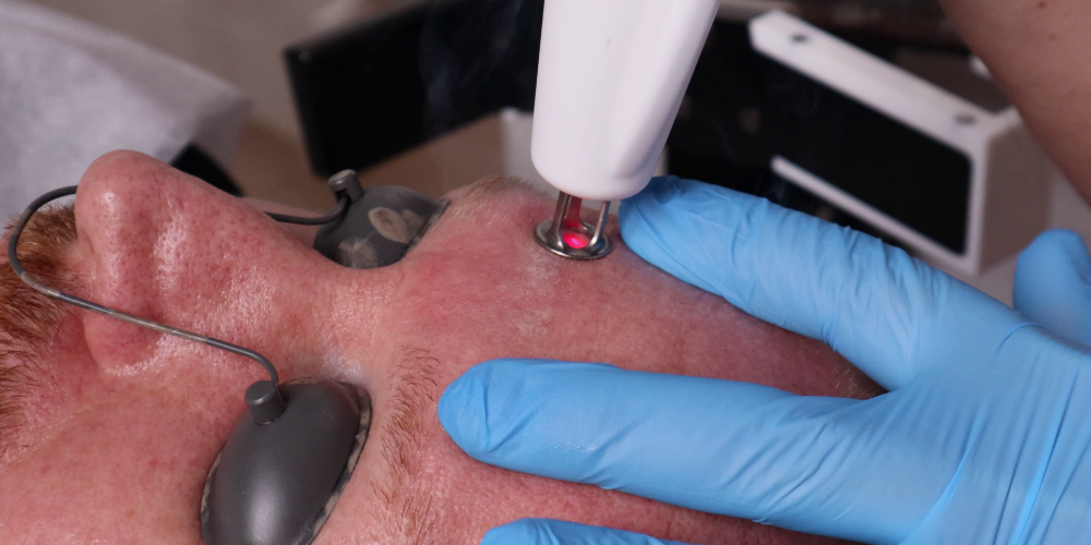 RecoSMA® - izrāviens lāzera reģenerācijas tehnoloģijā