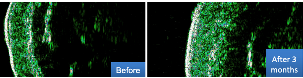 Ultraskaņas attēls DUB Cutis, 22 MHz